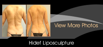 Hi-Def Liposuction