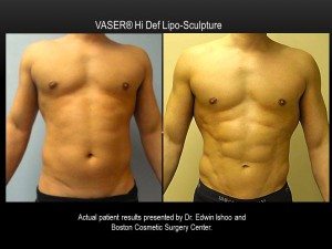 VASER-Hi-Def-2-Boston-Cosmetic-Surgery-