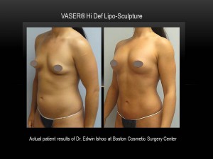 VASER-Hi-Def-boston-cosmetic-surgery-edwin-ishoo