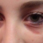 allergy-eyes-150x150