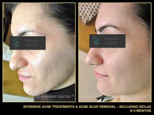 1067-intensive-acne-treatments-acne-scar-removal