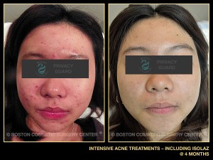 1070-intensive-acne-treatments-isolaz
