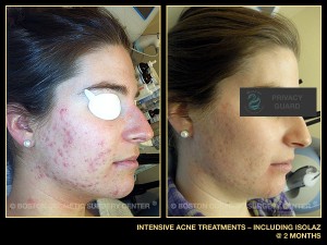 1071-intensive-isolaz-acne-treatments