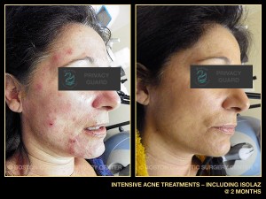 1074-intensive-acne-treatments-including-isolaz